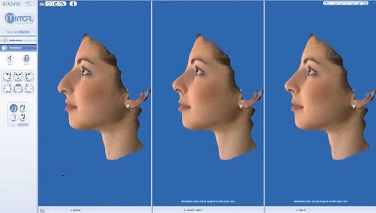 Ρινοπλαστική : Σύγκριση Πριν & Μετά την πλαστική στη μύτη (2εκδοχές)