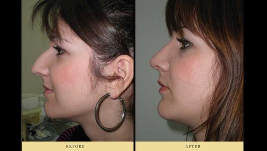 Ρινοπλαστική : Φωτογραφία Πριν & Μετά την πλαστική στη μύτη