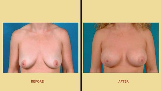 Αύξηση στήθους: Φωτογραφία πριν & μετά. Μπροστινή όψη