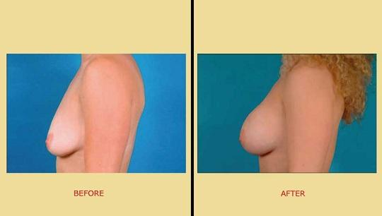 Αυξητική στήθους. Φωτογραφία πριν & μετά στο πλάι