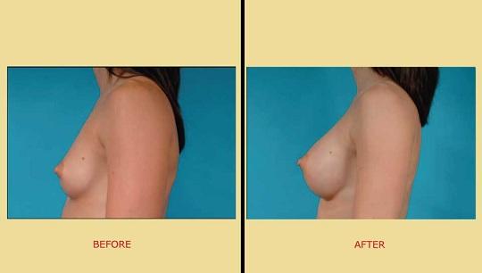 Αυξητική στήθους. Πριν & Μετά την πλαστική. Πλαινή όψη
