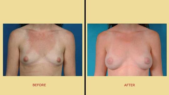 Πλαστική αυξητική στήθους. Φωτογραφία πριν & Μετά. Μπροστινή όψη
