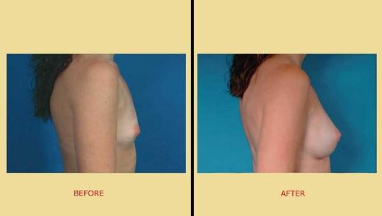 Πλαστική αυξητική στήθους. Αύξηση στήθους, Πλαινή όψη. Φωτογραφία πριν & μετά