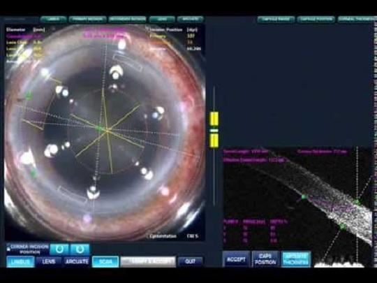 Καταρράκτης ματιών laser : Θεραπεία αντιμετώπιση