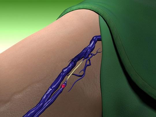Φλεβική ανεπάρκεια στα πόδια & θεραπεία με laser