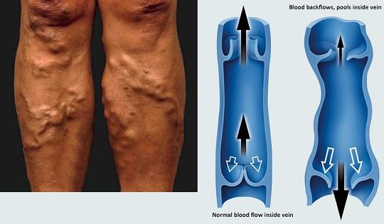 Κιρσοί κάτω άκρων κιρσοί στα πόδια θεραπεία αντιμετώπιση  με λέιζερ