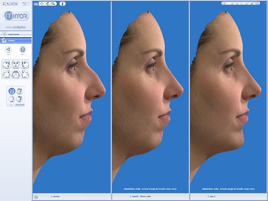 Ρινοπλαστική : πλαστική στη μύτη πριν και μετά την προσομοίωση με 3d