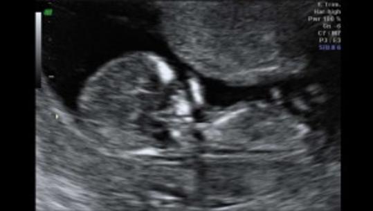 υπερηχογράφημα πρώτου τριμήνου εγκυμοσύνης αυχενική διαφάνεια