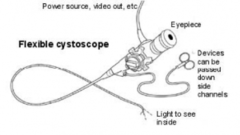 Κυστεοσκόπηση πως γίνεται κυστεοσκόπιο